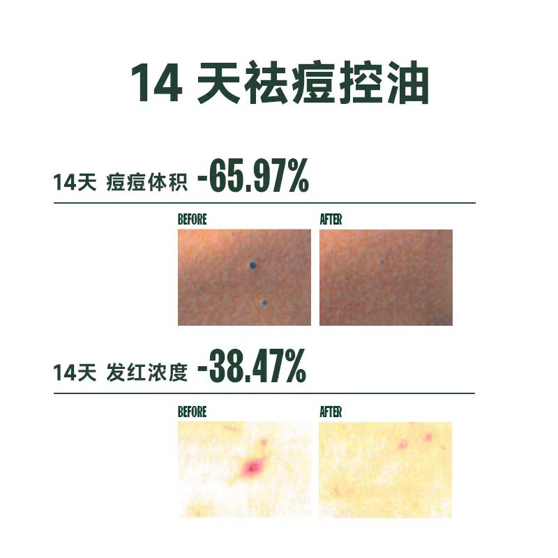 芙芙清透焕肤身体祛痘喷雾150ml